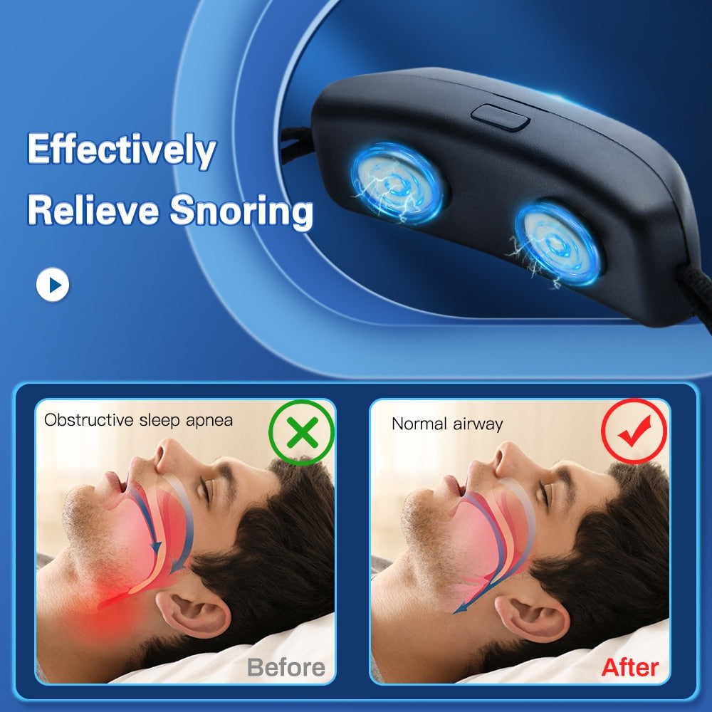 Anti-Snoring Device